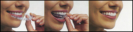 invisalign invisible braces