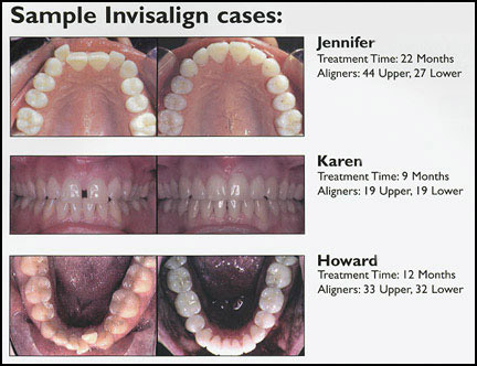 invisalign invisible braces