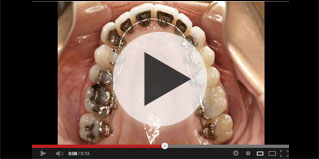 upper expansion video